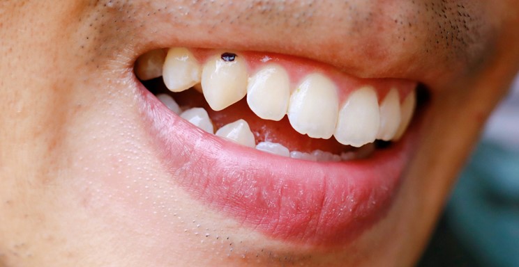 remove black spots from teeth